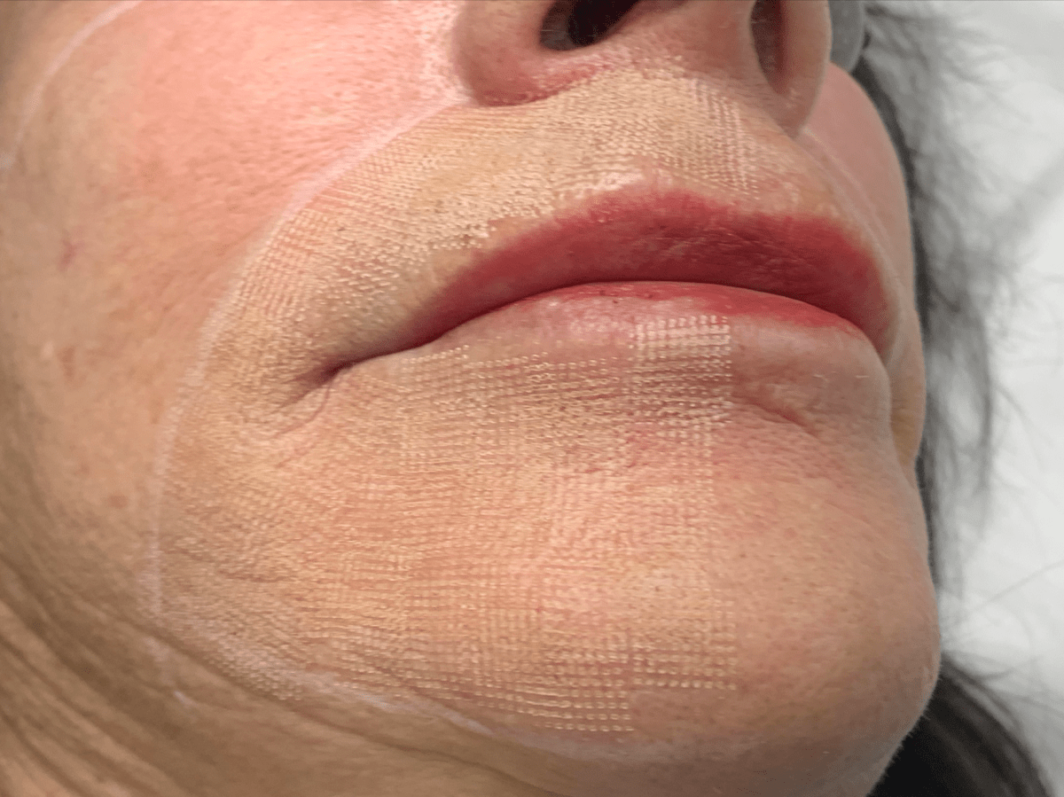 Fractional Laser Skin Resurfacing